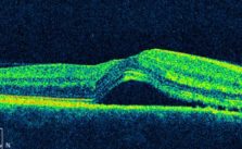 Color image of retina taken by Optical Coherence Tomography