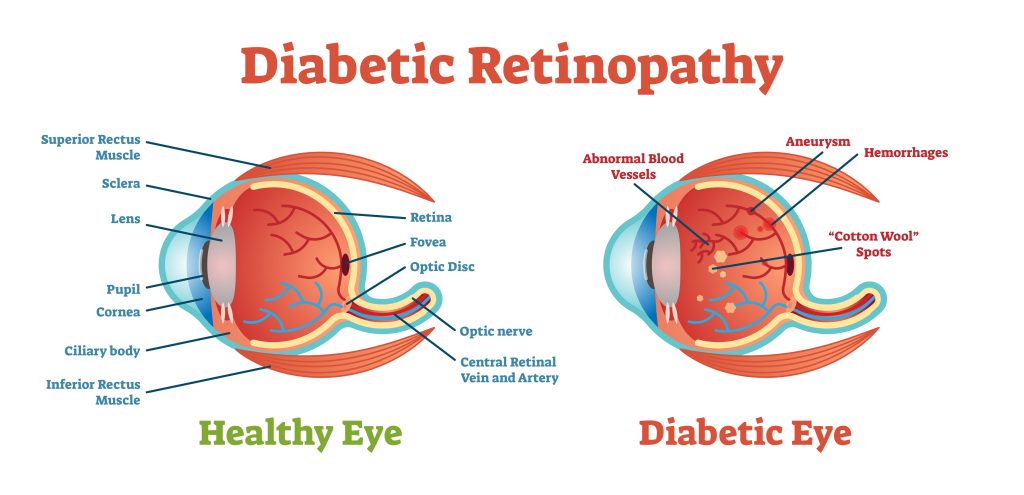 Diabetic Retinopathy vector illustration diagram, anatomical scheme. Medical educational information.