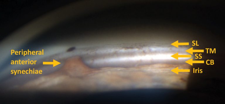 Gonioscopy Interpretation: Angle Anatomy, Shaffer Grading & When It’s ...